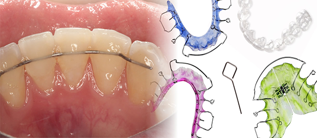 orthodontic braces retainers wire wear should retainer getting removable dental before know pain important wearing orthodontist dentist windsor things dentists