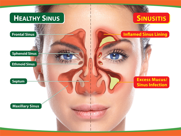 Nasal and Sinus Diseases Symptoms and Causes - Featured ...